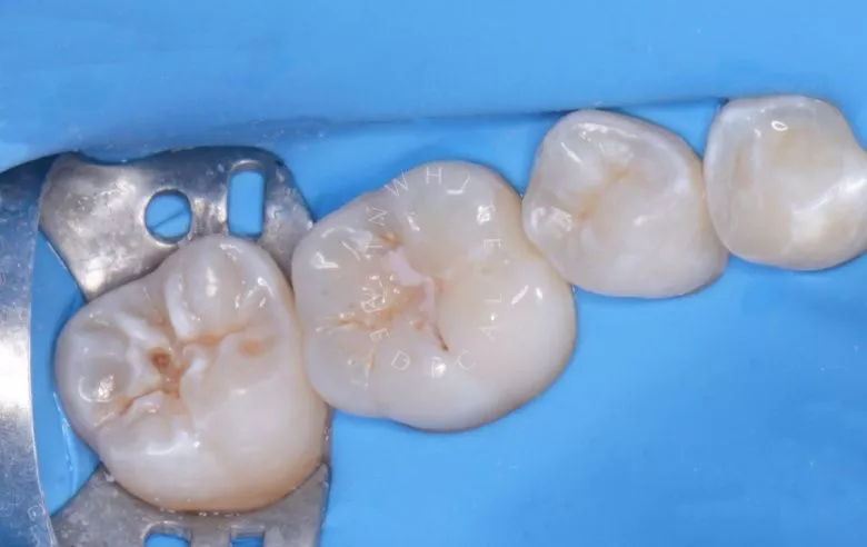 Лучшие детские стоматологии. Лечение кариеса жевательных зубов у детей - фото до процедуры