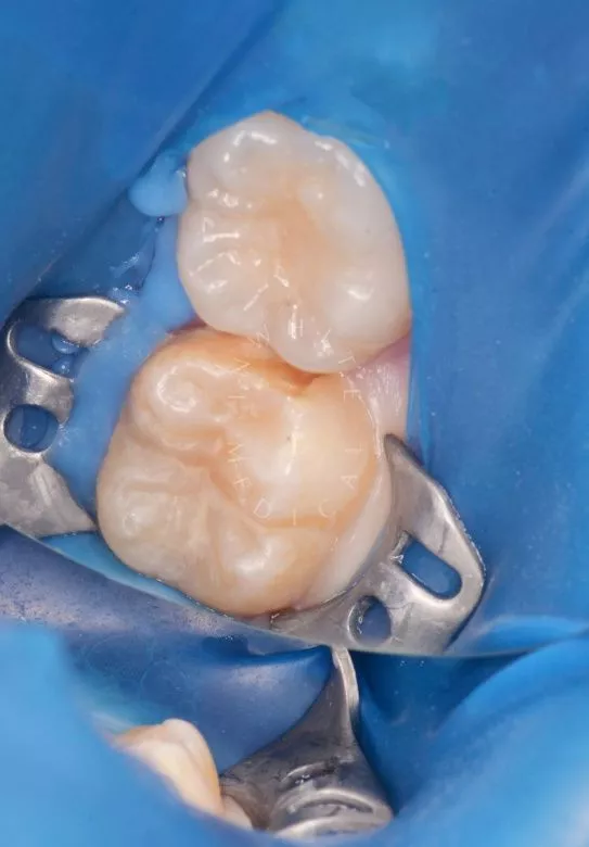  - фото до процедуры