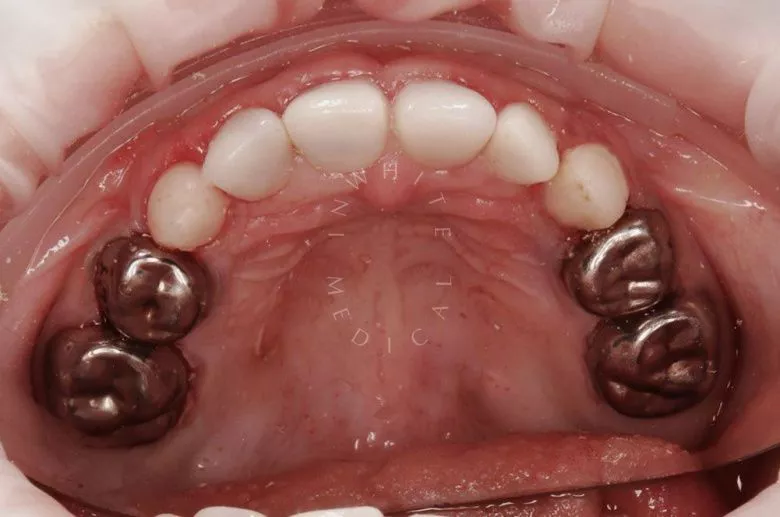 Фото после Лечение зубов с установкой керамических и железных коронок у детей в клинике Inwhite Medical