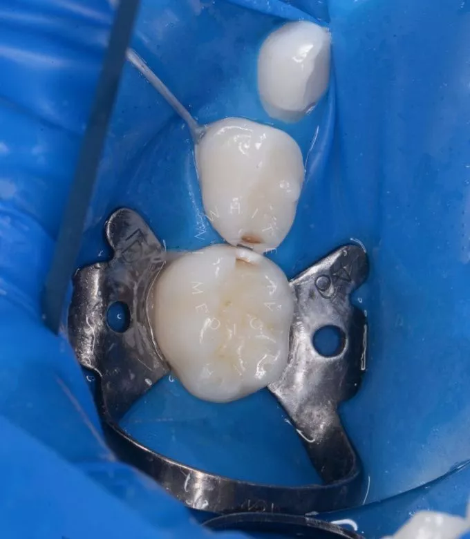 Самые лучшие детские стоматологи. Лечение контактного кариеса двух зубов - фото до процедуры