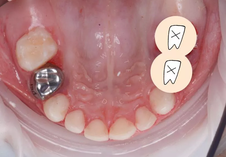 Фото после Лечение молочных зубов и установка металлических коронок во сне в клинике Inwhite Medical