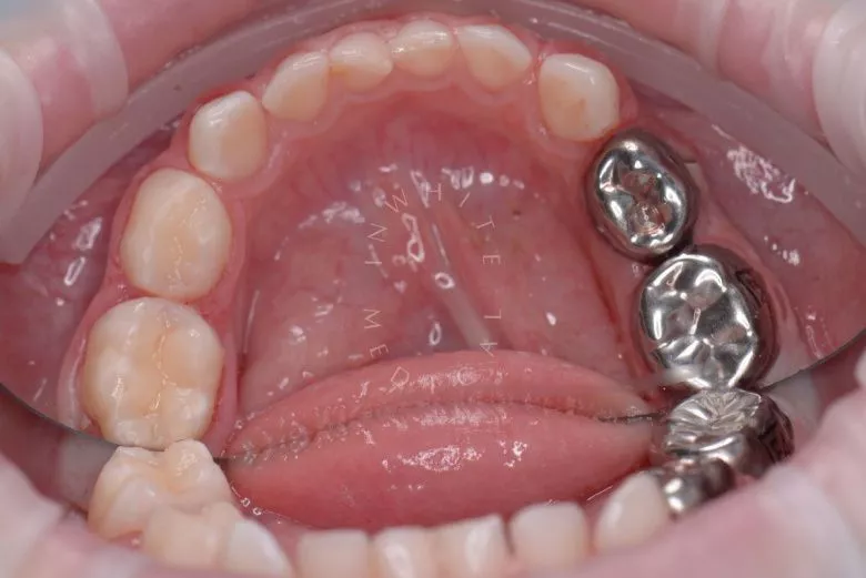 Самые лучшие детские стоматологи. Лечение кариесов и установка металлических коронок детям - фото после процедуры