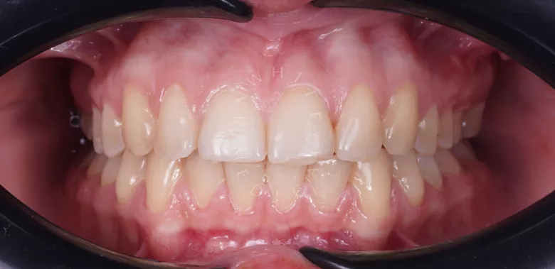 Фото после процедуры