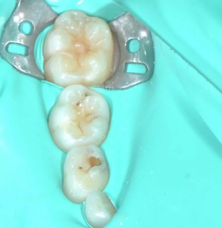 Лучшие стоматология для детей. Лечение кариесов и герметизация фиссур у детей - фото до процедуры