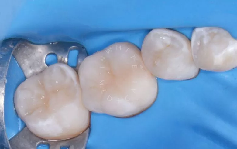 Лучшие детские стоматологии. Лечение кариеса жевательных зубов у детей - фото после процедуры