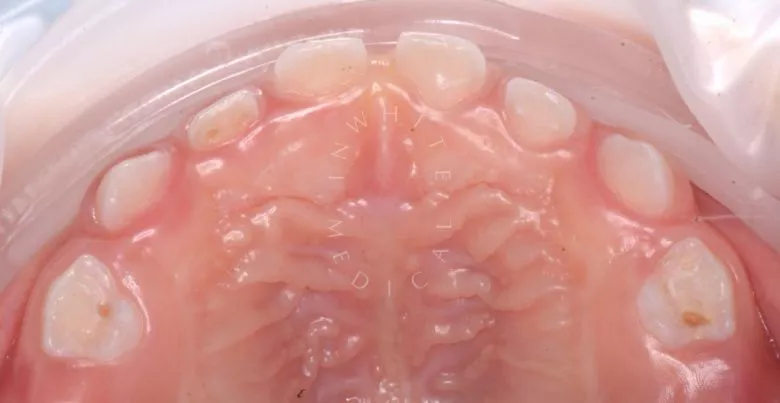 Лучшие стоматология для детей. Лечение детей в наркозе - установка металлических коронок - фото до процедуры