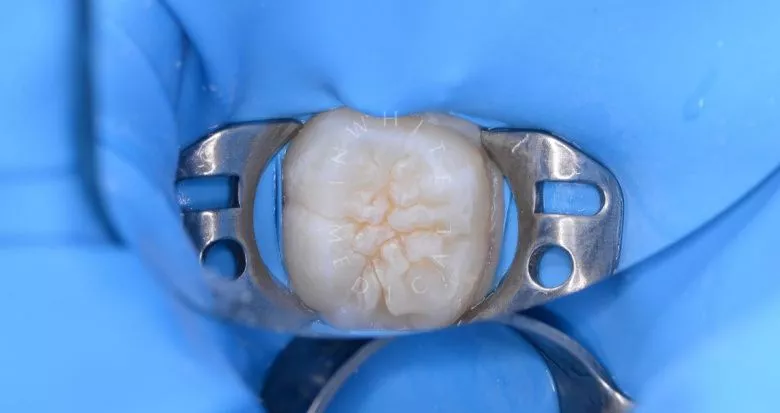 Лучшие детские стоматологии. Герметизация фиссур - фото после процедуры