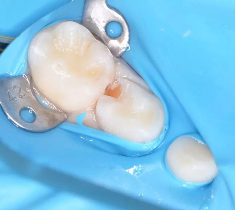 Лучшие стоматология для детей. Лечение контактного кариеса зуба - фото до процедуры