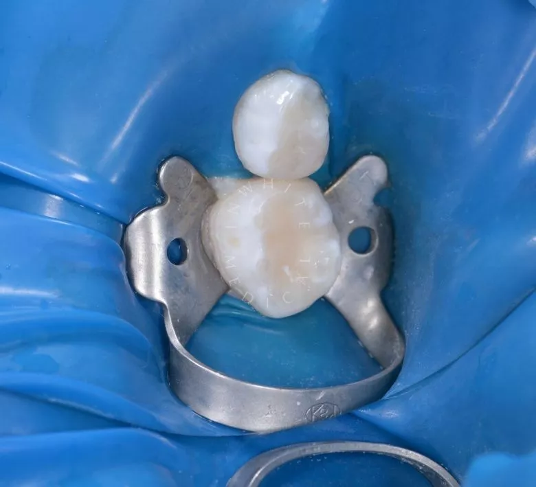 Самые лучшие детские стоматологи. Лечение кариеса и герметизация фиссур - фото после процедуры