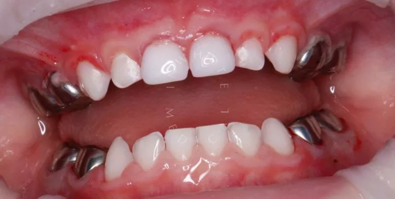 Лучшие стоматология для детей. Лечение детей под наркозом - фото после процедуры