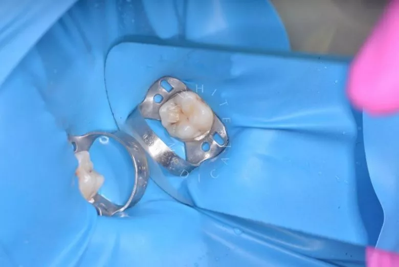 Лучшие стоматологии детские платные. Лечение кариеса жевательного зуба - фото до процедуры