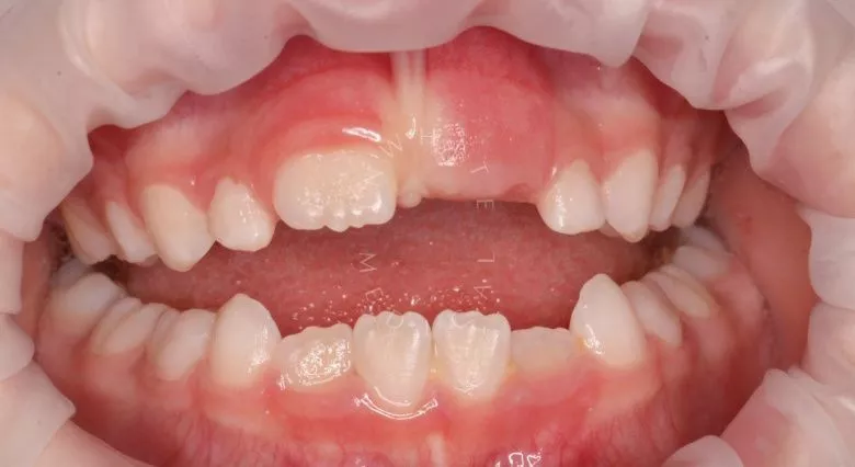 Самые лучшие детские стоматологи. Профессиональная гигиена зубов у детей - фото до процедуры