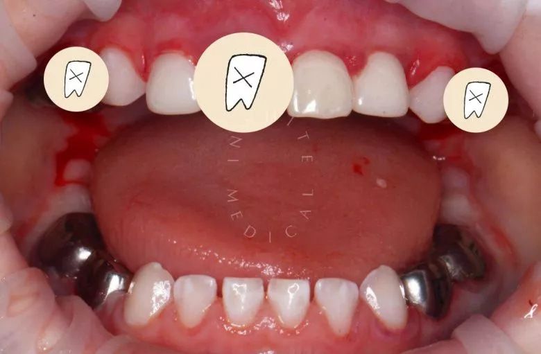 Лучшие стоматология для детей. Лечение во сне - установка коронок, удаление зубов и проведение профессиональной гигиены - фото после процедуры