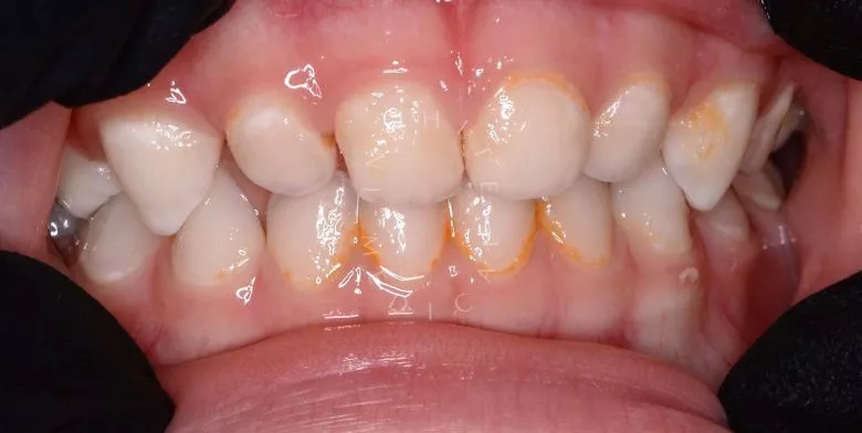 Лучшие стоматология для детей. Профессиональная гигиена для детей - фото до процедуры