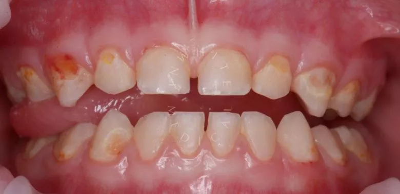 Лучшие детские стоматологии. Лечение во сне - установка коронок, удаление зубов и гигиена полости рта - фото до процедуры