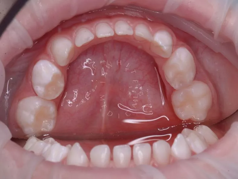  - фото после процедуры