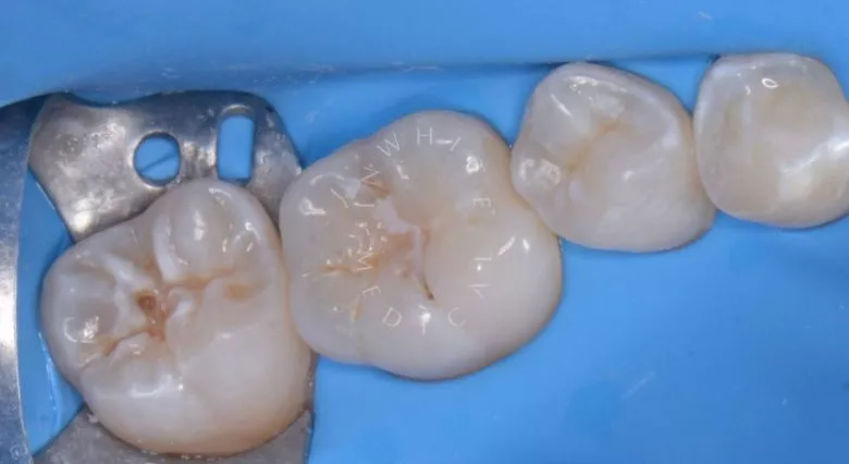 Лучшие стоматологии детские платные. Лечение кариеса у детей - фото до процедуры