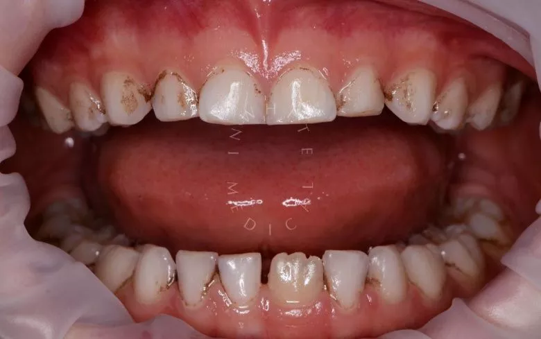 Лучшие стоматология для детей. Гигиена зубов в сменном прикусе - фото до процедуры