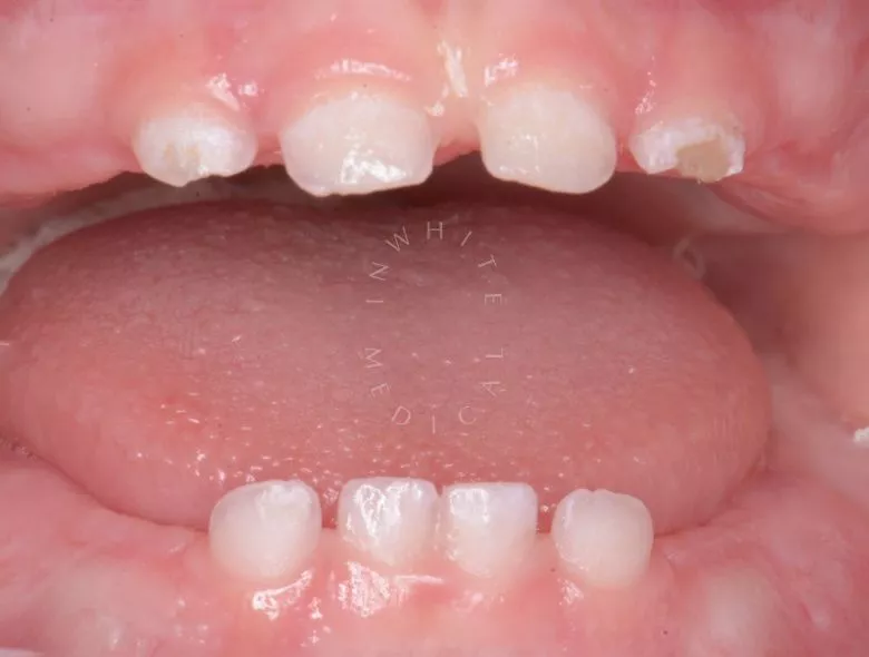 Лучшие стоматологии детские платные. Лечение под наркозом - установка коронок и профессиональная гигиена - фото до процедуры