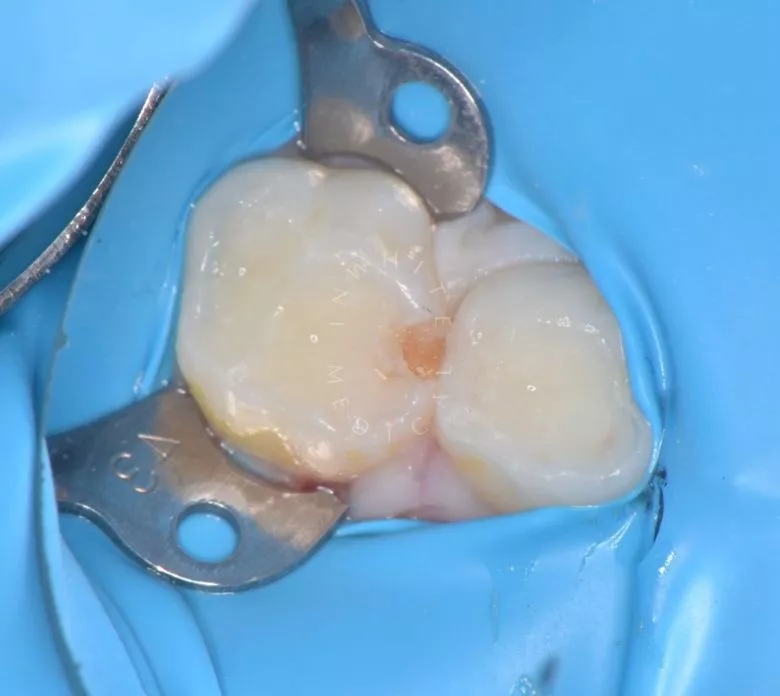 Лучшие стоматология для детей. Лечение межзубного кариеса у детей - фото до процедуры