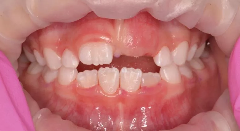 Самые лучшие детские стоматологи. Профессиональная гигиена зубов у детей - фото после процедуры