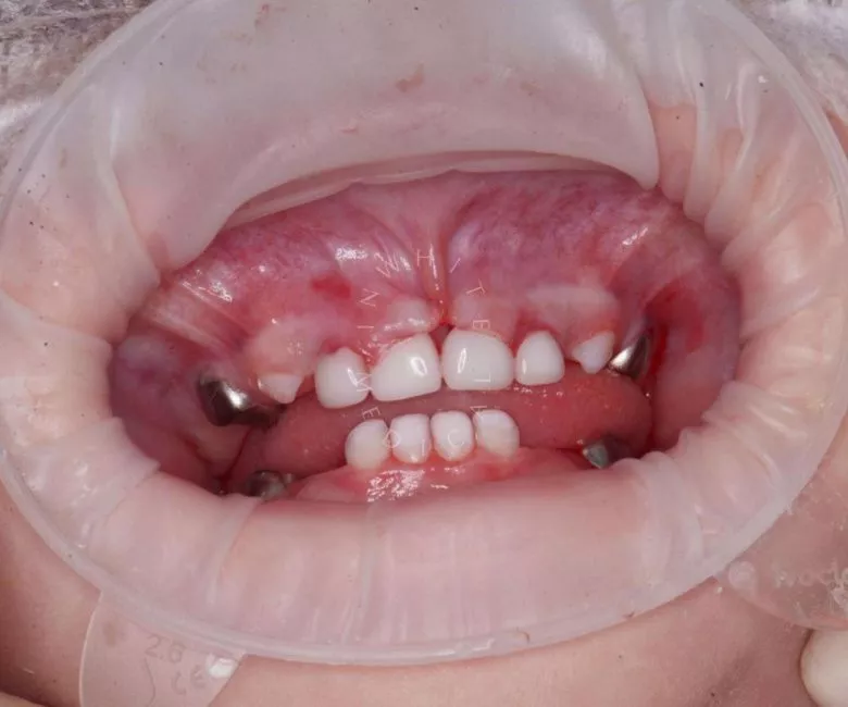 Лучшие стоматологии детские платные. Лечение молочных зубов во сне - фото после процедуры