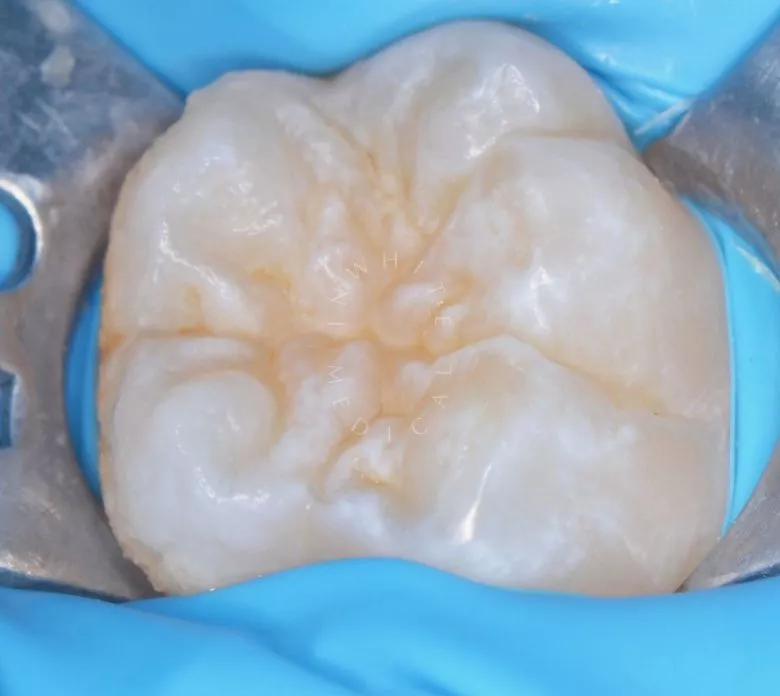 Лучшие стоматология для детей. Герметизация фиссур постоянного зуба у детей - фото до процедуры