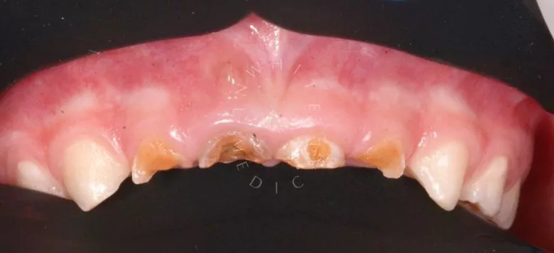 Лучшие стоматология для детей. Лечение зубов в наркозе детей - фото до процедуры