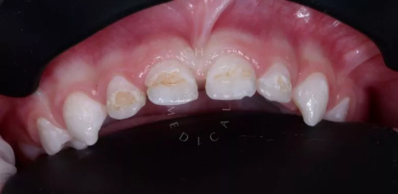 Фото до Установка коронок и лечение зубов детям во сне в клинике Inwhite Medical