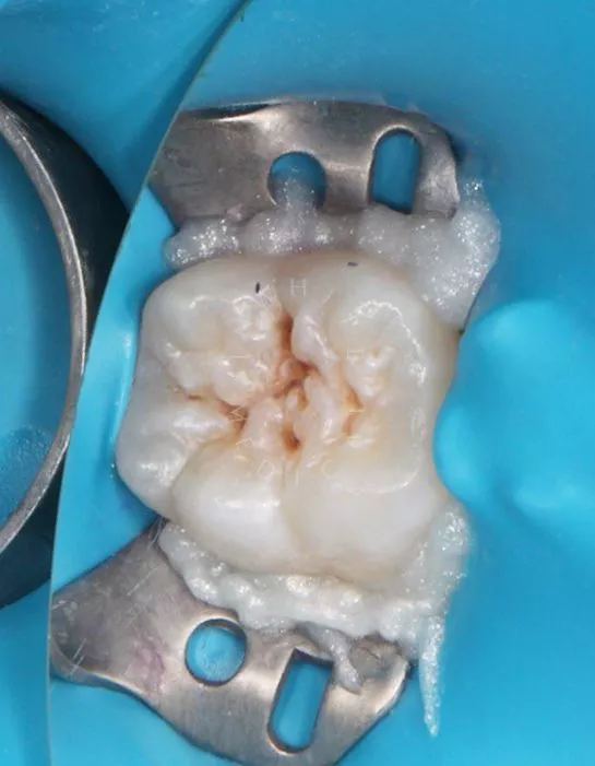 Детская стоматология лечение во сне. Лечение кариеса постоянного зуба у подростка - фото до процедуры