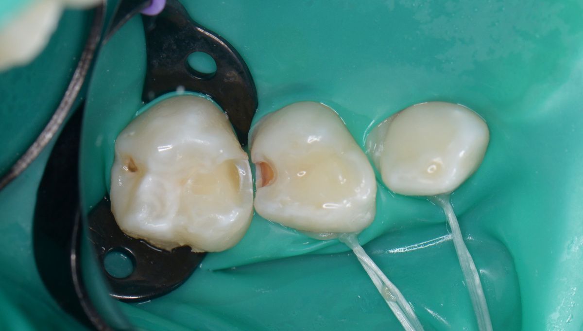  - before the procedure