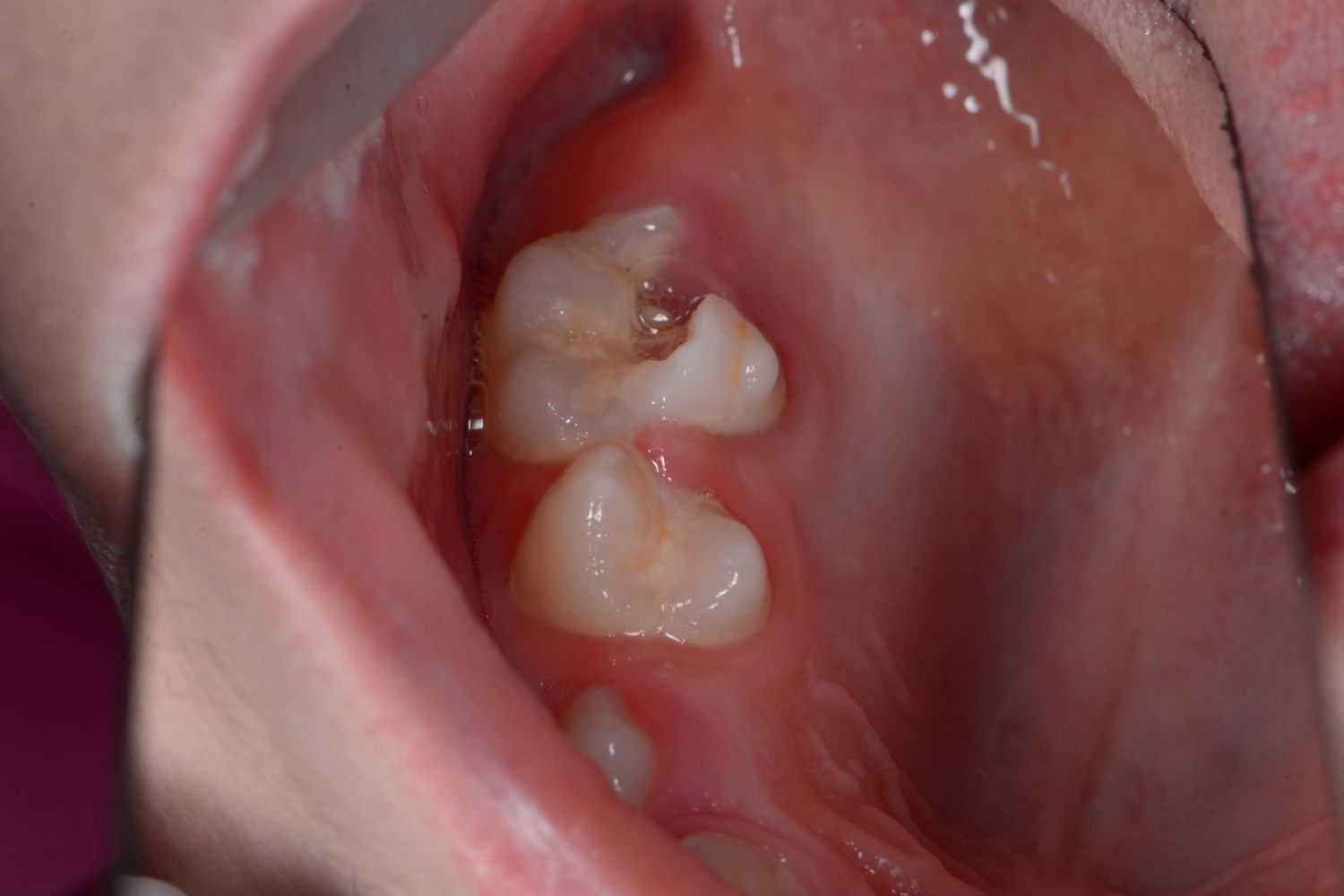  - before the procedure