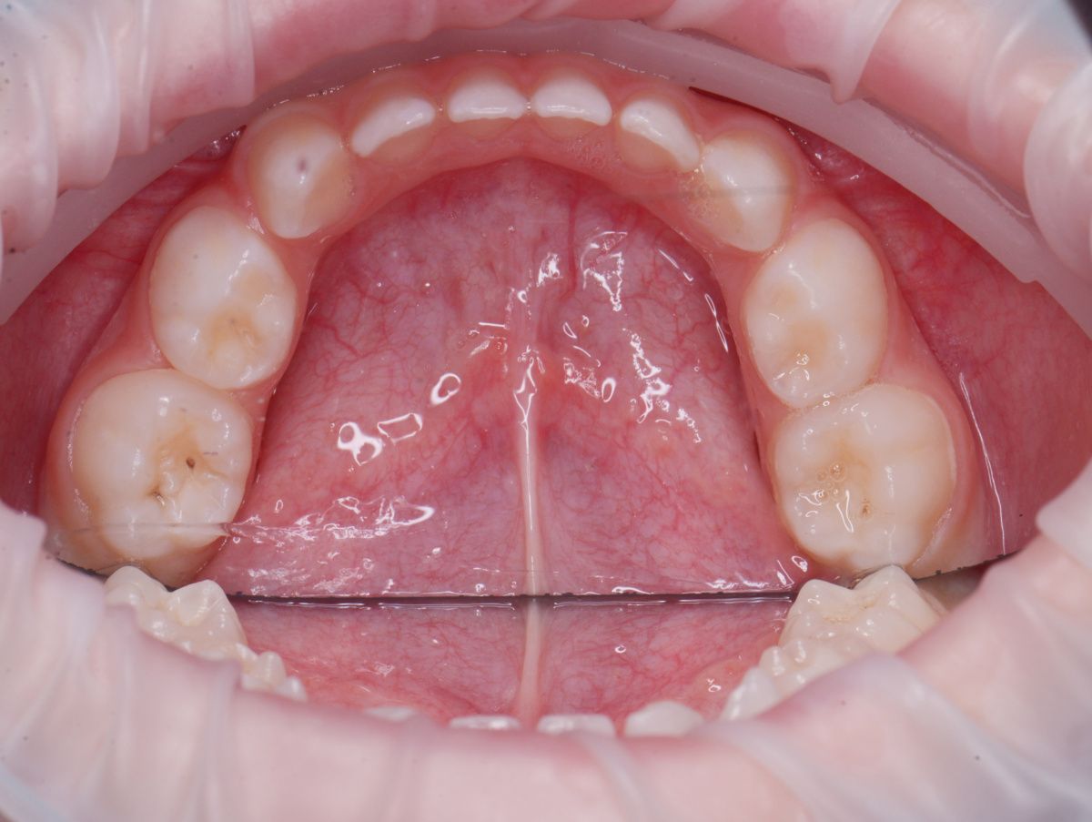  - before the procedure