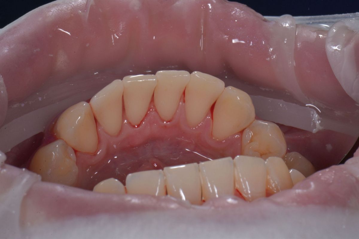 Профессиональная гигиена нижних зубов