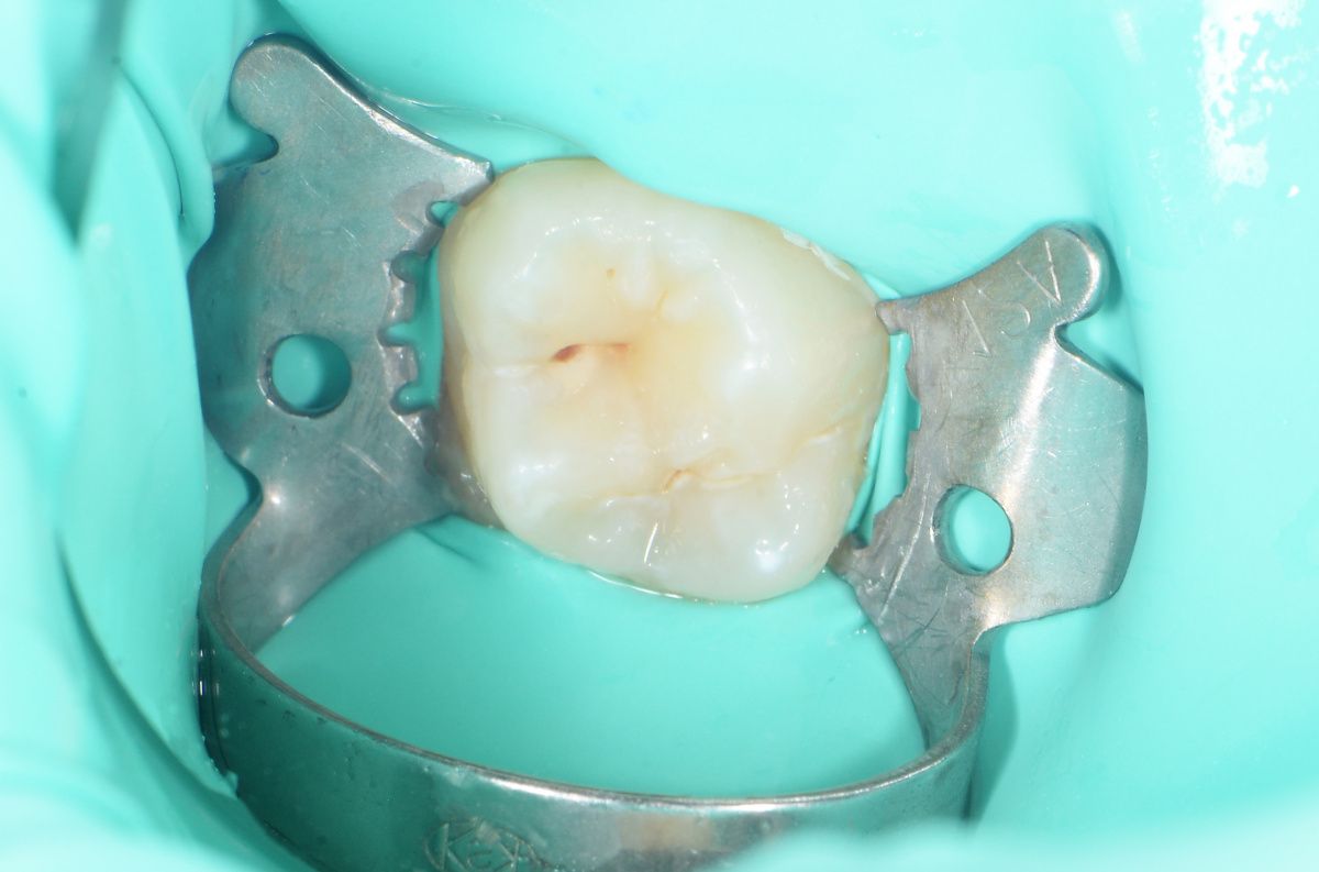  - before the procedure