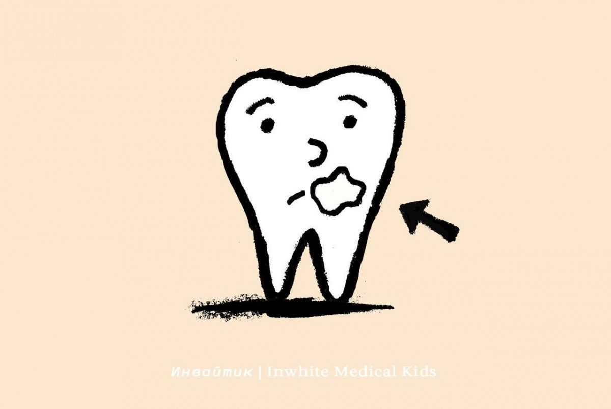 Как проходит лечение кариеса в стадии пятна у детей?