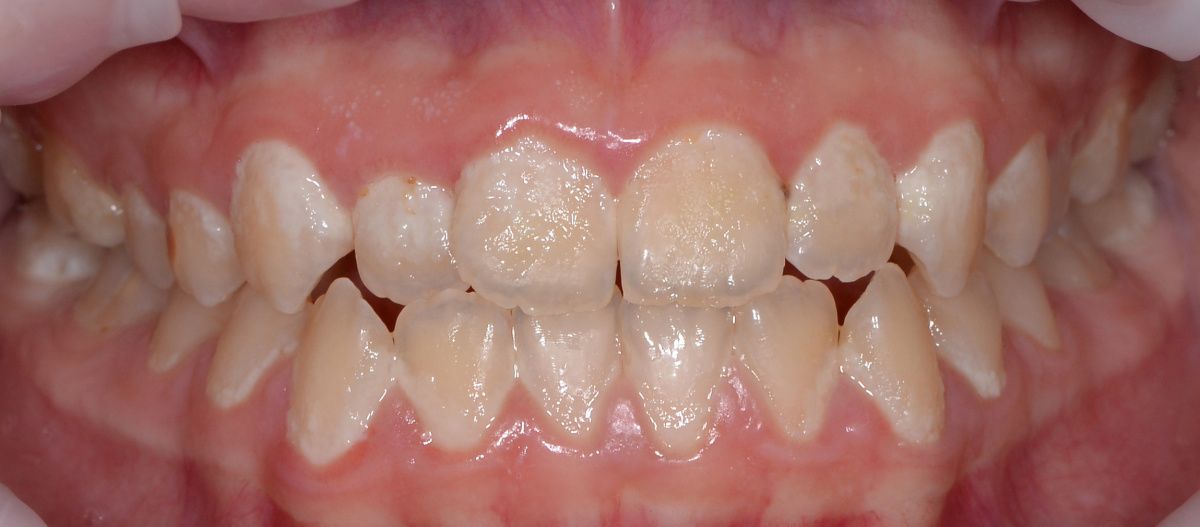  - before the procedure
