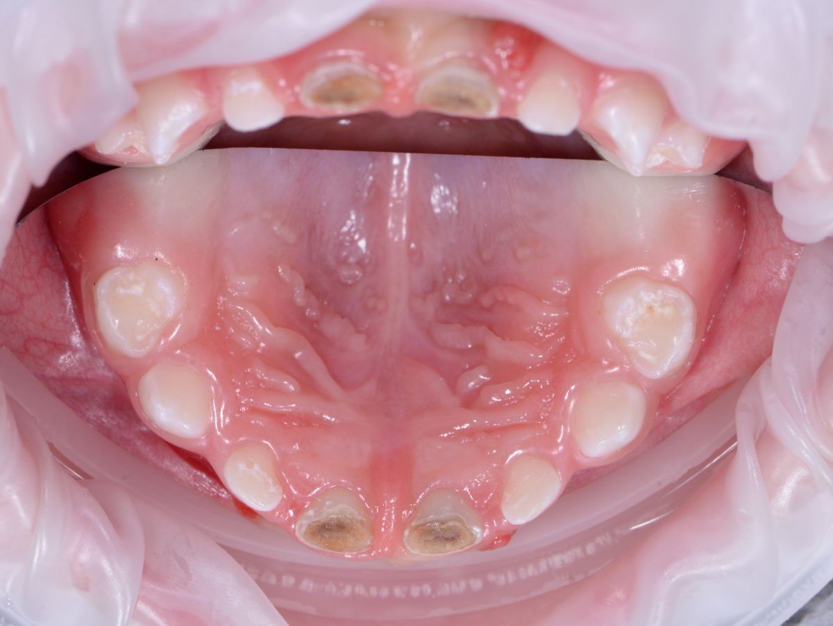 - before the procedure