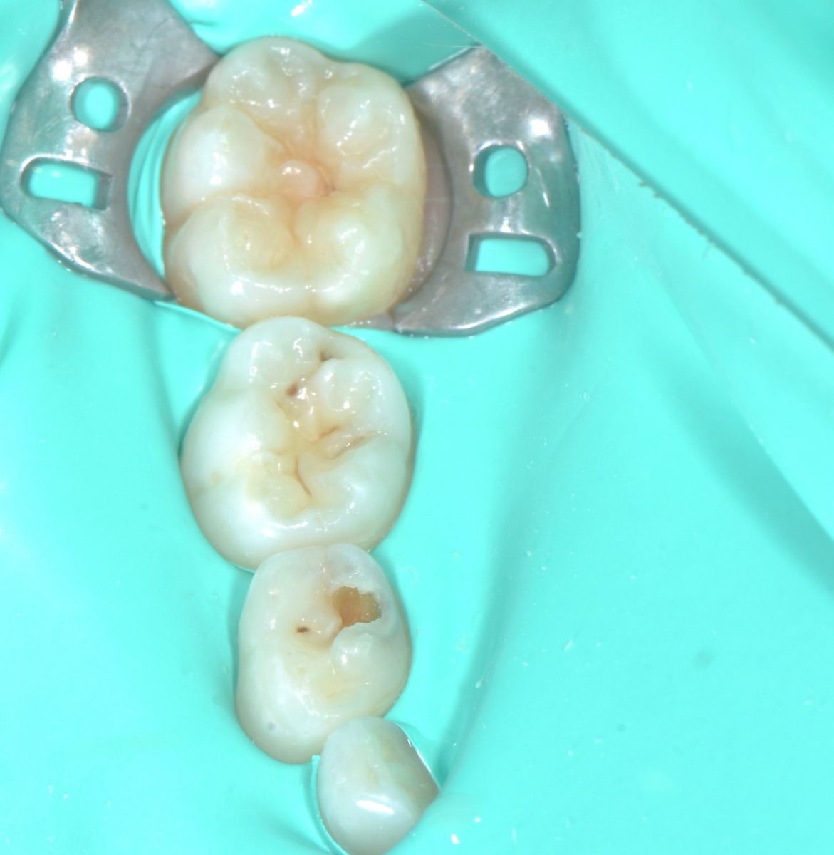  - before the procedure