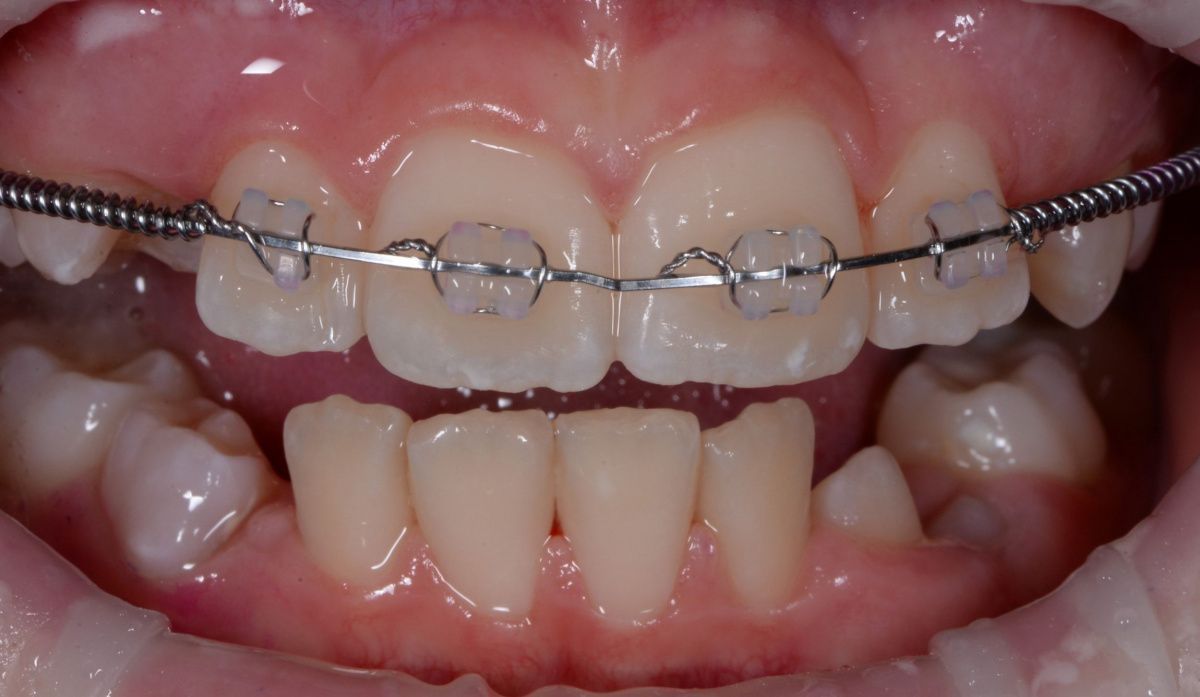 Гигиена у ребенка с частичной брекет-системой