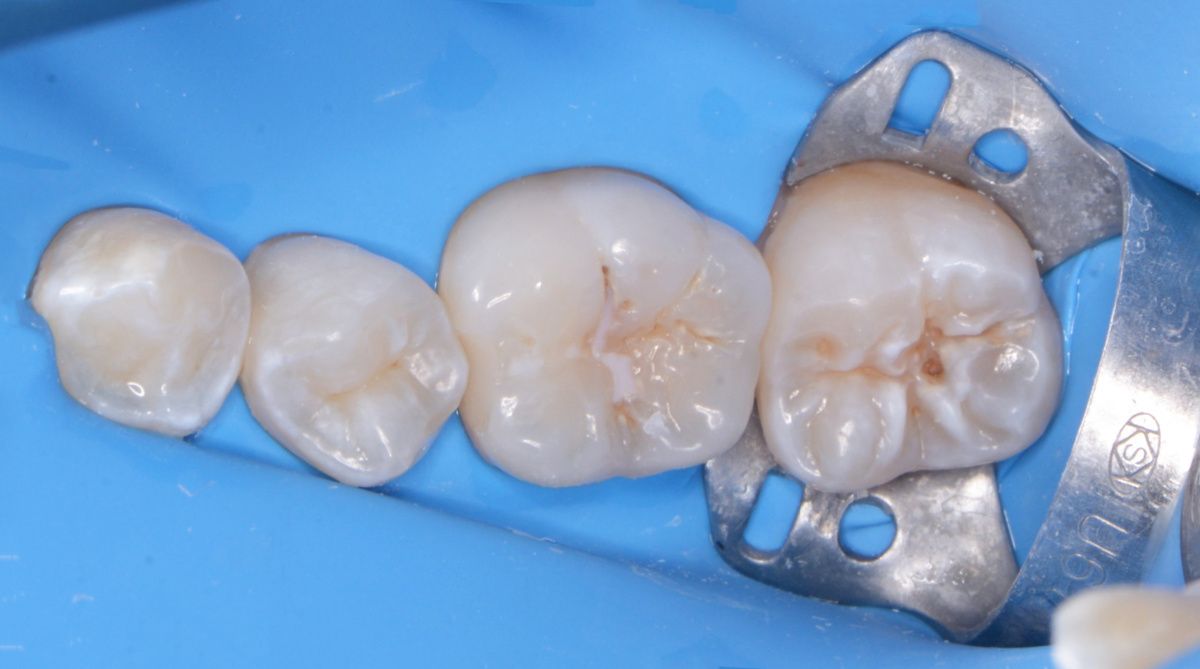 - before the procedure