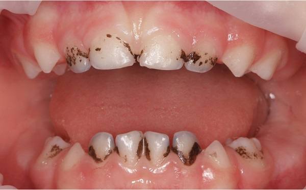 Почему появляется налёт Пристли на зубах у детей ?