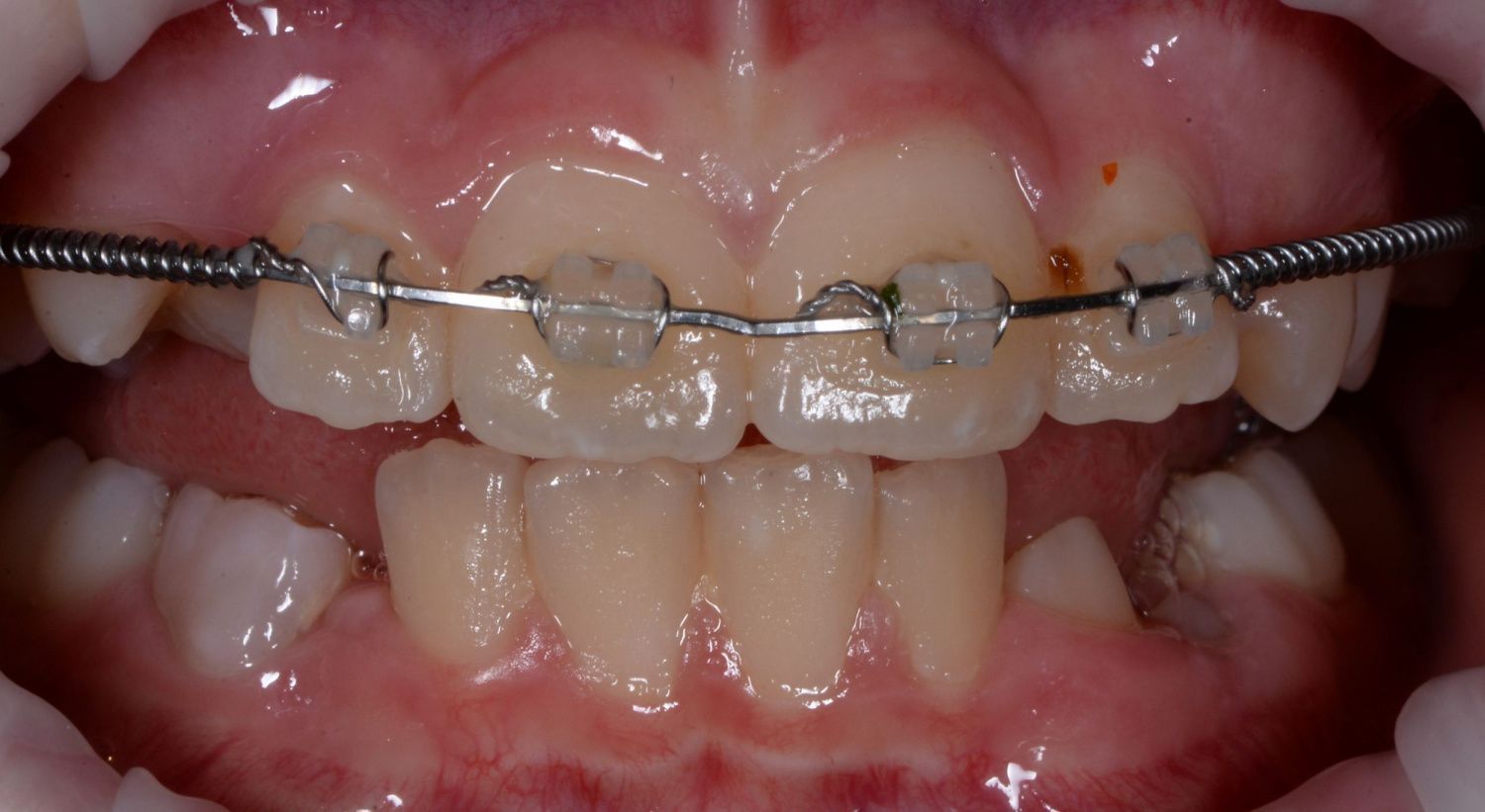  - before the procedure
