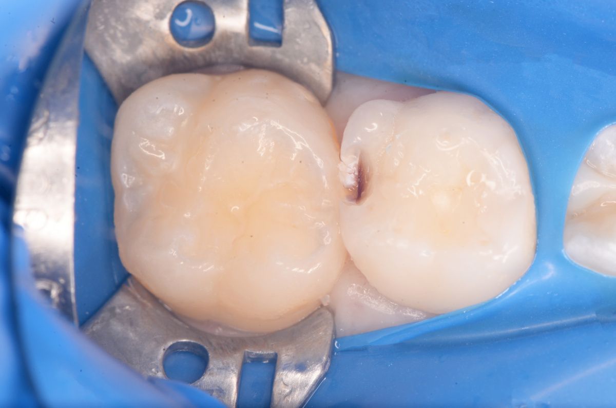  - before the procedure