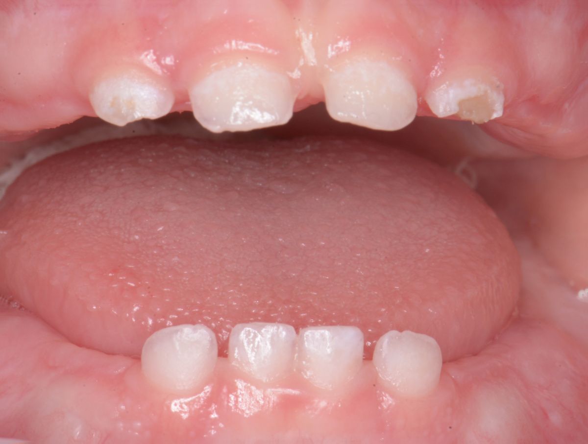  - before the procedure