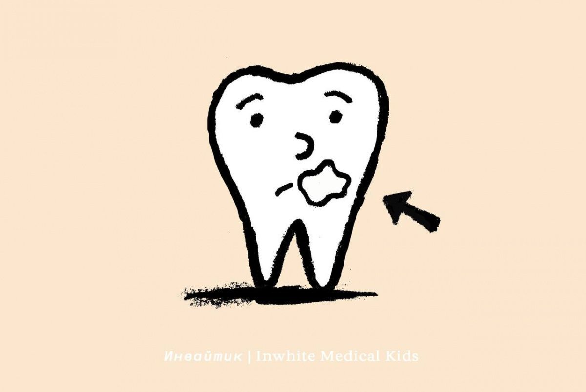 У ребёнка появилось белое пятнышко на зубе. Это кариес?