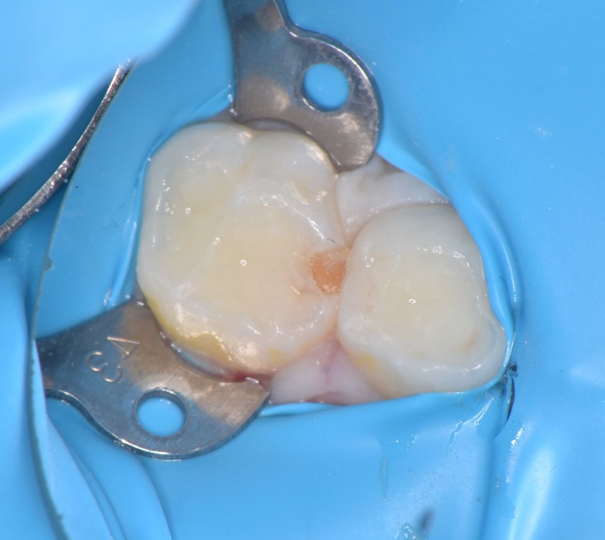  - before the procedure
