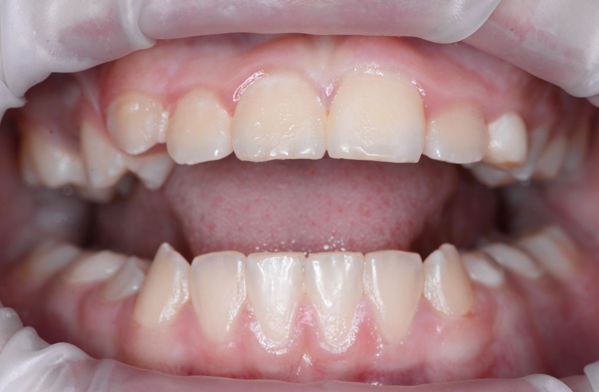  - before the procedure