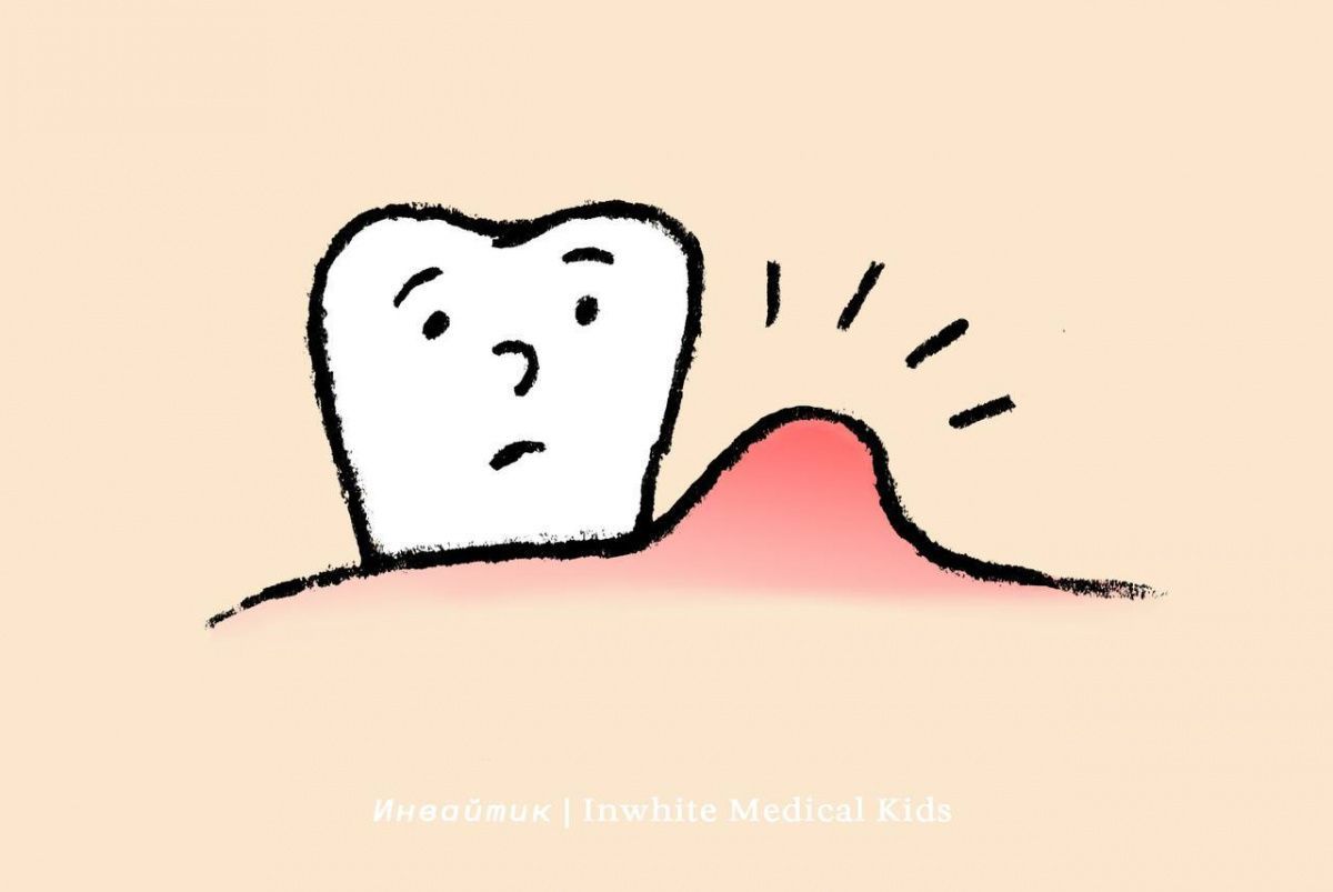 Можно ли спасти молочный зуб со свищом?