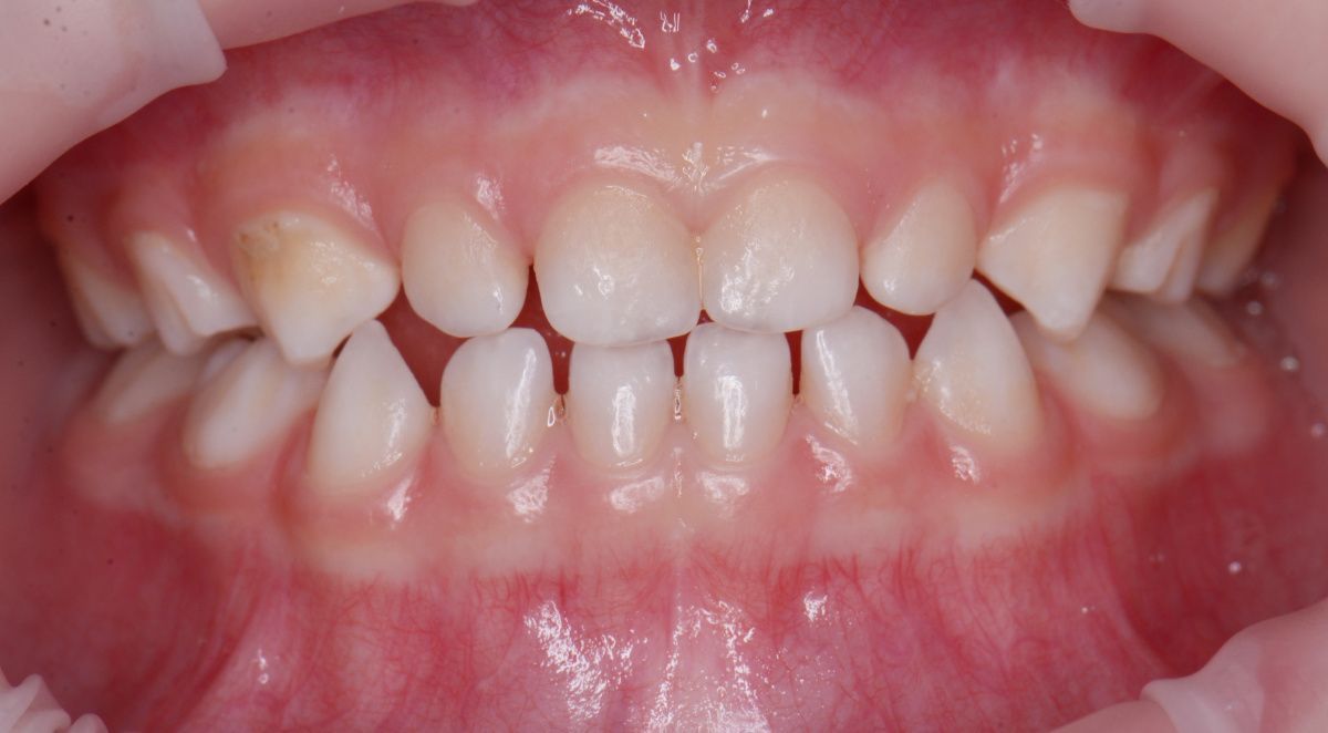  - before the procedure